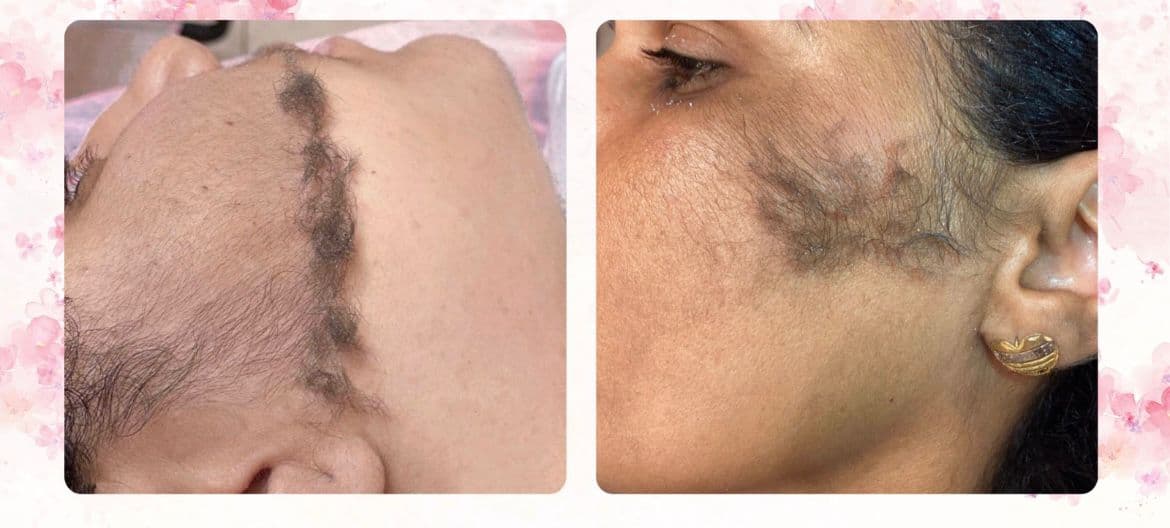 Dermaplaning facial em Goiânia na AB Sobrancelhas